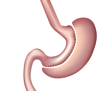 Sleeve Gastrectomy Illustration