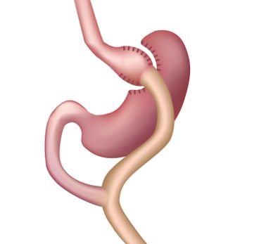 Gastric Bypass Illustration